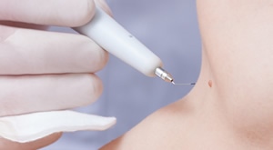 [ZAGREB] Poliklinika VitalArt donosi odličnu ponudu za NEKIRURŠKO uklanjanje do 3 madeža, bradavice ili lipoma inovativnim aparatom Plasmage uz  pregled i lokalnu anesteziju!