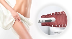 [ZAGREB] Izaberite 1 ili 3 vaginalna HIFU tretmana u ordinaciji dr. Šeba! Jedinstveni BEZBOLNI aparat u Hrvatskoj rješava inkontinenciju i menopauzu. Vratite komfor bez operacije već od 199 €!