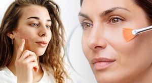 Ugrabi ACNE RESET paket za čisto lice bez upala! Salon Val Beauté Zagreb nudi napredni tretman za DUBINSKO čišćenje kože: mehaničko čišćenje, moćan Mesoestetic kemijski peeling i pregled!